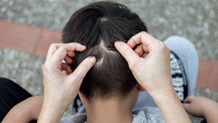 Cara Merawat Rambut Yang Efektif Hilangkan Kutu