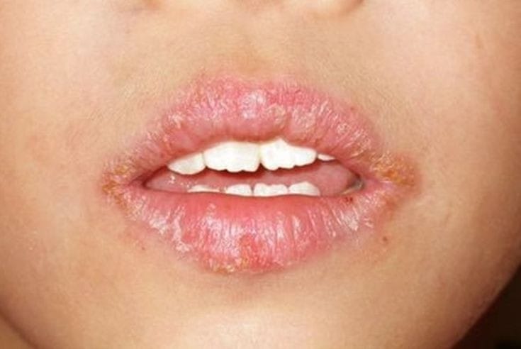 Mencegah Bibir Kering dengan Mudah! Lakukan 6 Langkah ini di Jamin Ampuh!