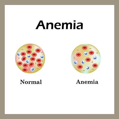 Kenali Gejala Anemia dan 3 Cara Mengatasi Anemia dengan Tepat