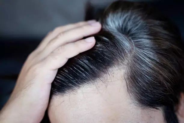 4 Cara Menggunakan Lidah Buaya untuk Atasi Rambut Uban : Rambut Putih Auto Hilang!