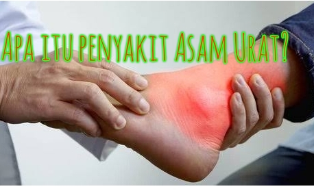 Apa Itu Penyakit Asam Urat Ini Dia Penyebab Gejala Serta Pencegahannya