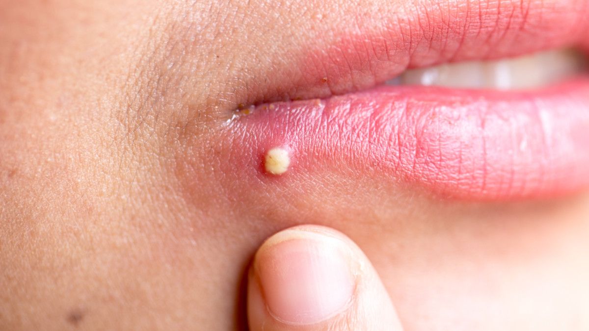 Jerawat di Bawah Bibir: 5 Tips Perawatan dan Perbedaannya dengan Herpes