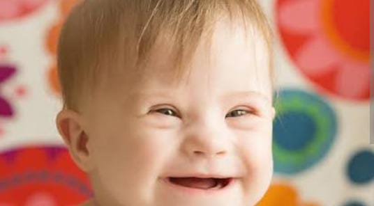 Kenali Penyakit Down Syndrome Apabila Terjadi Pada Anak Kita! 