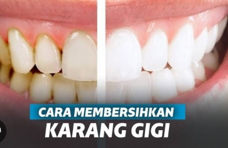 Mudah Banget! Ini Dia Penyebab dan Cara Membersihkan Karang Gigi, Bau Mulut Hilang