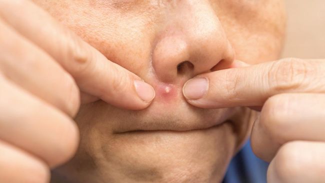 Cara Mengatasi Jerawat di Hidung: 7 Tips Ampuh Untuk Kulit Bebas Jerawat!