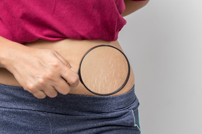 Bye Bye Stretch Mark. Berikut Rekomendasi untuk Menghilangkan Garis di Badan