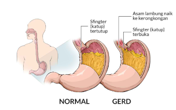 Kenali Penyebab Asam Lambung dan Cara Mengatasinya