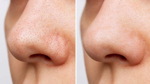 Tips Menghilangkan Komedo di Hidung dengan Cepat dan Alami