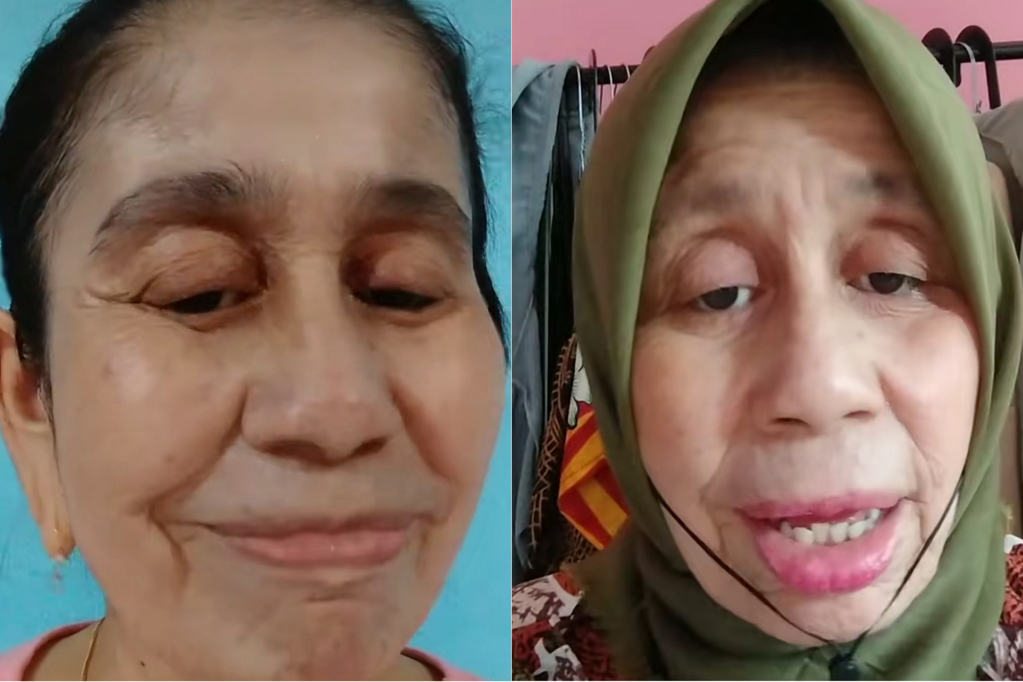 Kasihan! Wanita Usia 28 Tahun Tapi Wajahnya Seperti Nenek-nenek, Apa Nama Penyakitnya? 