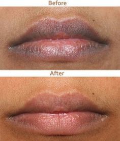 Punya Bibir yang Hitam? Berikut Ini Cara menghilangkan Bibir Hitam Secara Alami