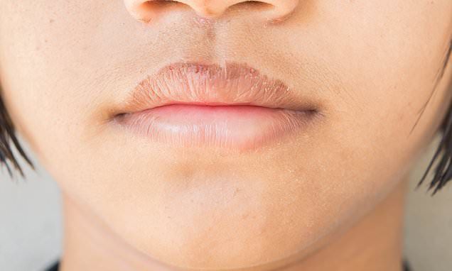 Bibir Hitam? Berikut 8 Penyebab yang Membuat Bibir Menjadi Hitam