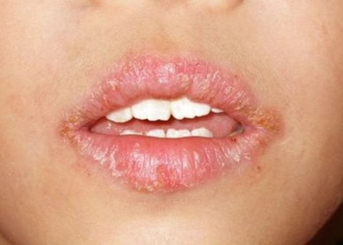 Mencegah Bibir Kering dengan Mudah! Lakukan 6 Langkah ini di Jamin Ampuh!