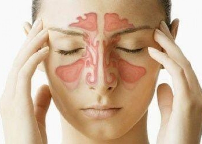 Mengapa Bisa Terjadi Sinusitis? Simak Gejala, Penyebab dan Cara Mengatasinya!