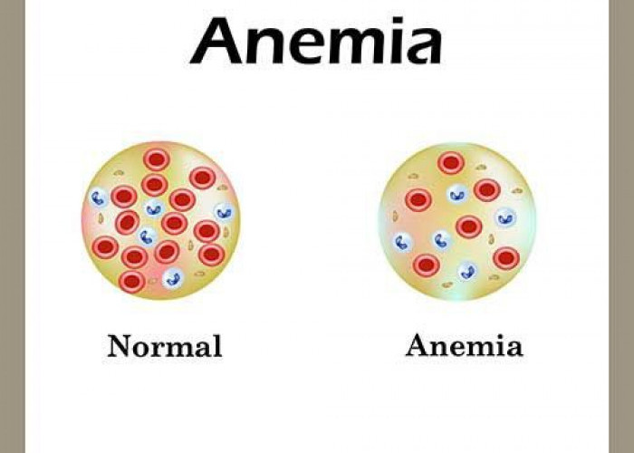 Kenali Gejala Anemia dan 3 Cara Mengatasi Anemia dengan Tepat