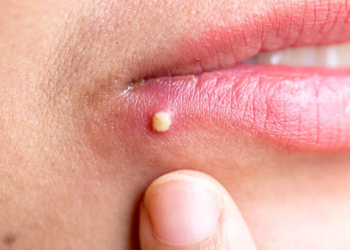 Jerawat di Bawah Bibir: 5 Tips Perawatan dan Perbedaannya dengan Herpes