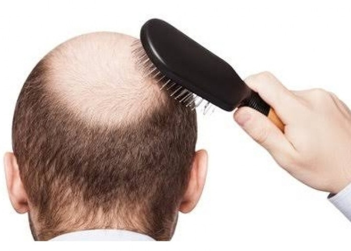 Rambut Rontok Memicu Kebotakan, Ini Penyebab dan Cara Mengatasinya
