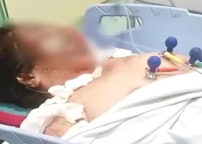 Wanita Lansia di Jepara Meninggal, Luka Sekujur Tubuh Akibat Dibakar Mantan Menantu