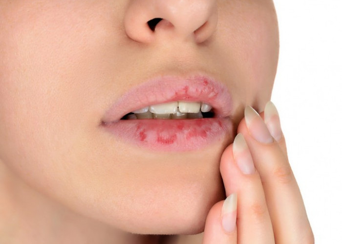 Selain Menggunakan Madu, Ini 6 Cara Mengatasi Bibir Kering dan Pecah Secara Alami