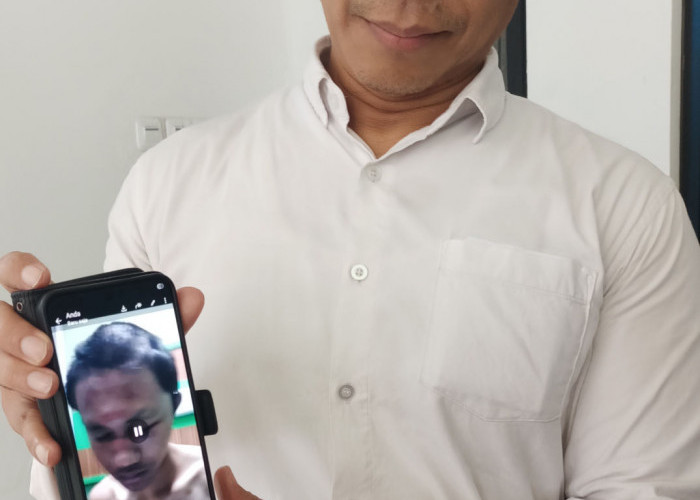 Diduga Dikeroyok 30 Mahasiswa, Mahasiswa Undip Alami Patah Hidung dan Gegar Otak