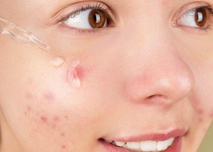 Keluhan Jerawat di Wajahmu Tak Kunjung Selesai? Inilah 7 Kandungan Skincare yang Ampuh Menghilangkan Jerawat