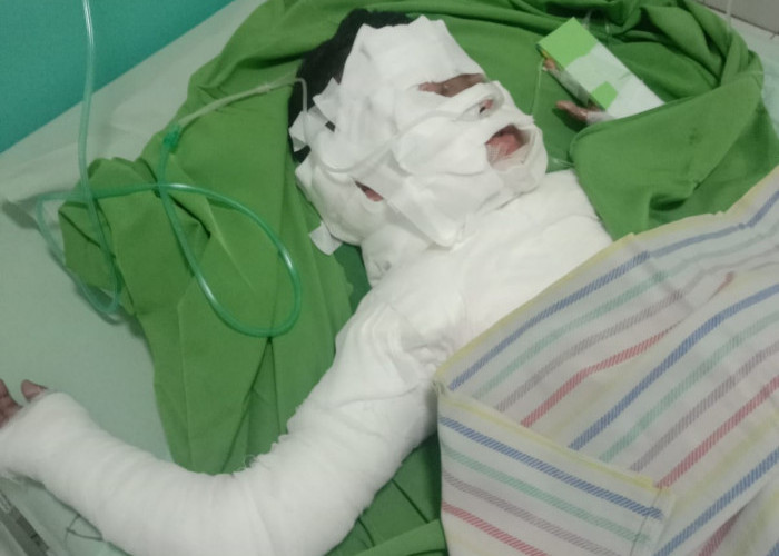 Bocah 9 Tahun Terbakar Saat Bermain di Proyonanggan Selatan Kabupaten Batang, Ini Kronologinya