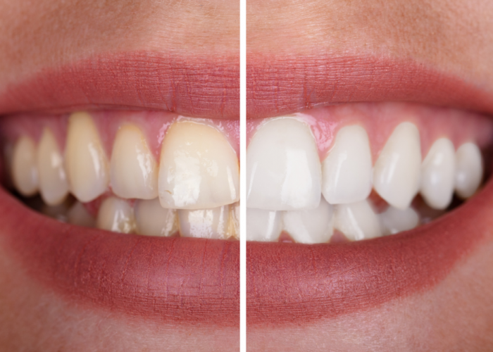 Segera Hentikan! Berikut 8 Kebiasaan yang Bisa Membuat Gigi Anda Jadi Kuning