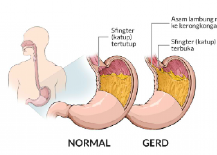 Kenali Penyebab Asam Lambung dan Cara Mengatasinya