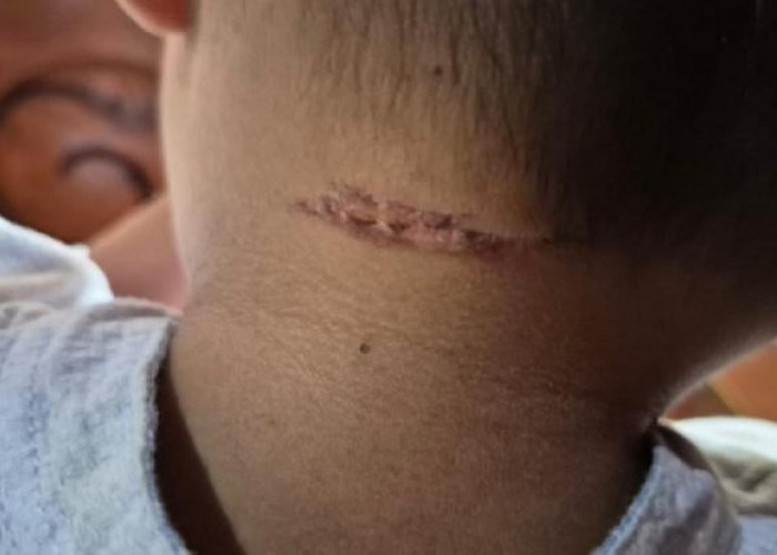 Seorang Bocah Diduga Dianiaya Pengasuh, Ayah Lapor ke Polres Grobogan