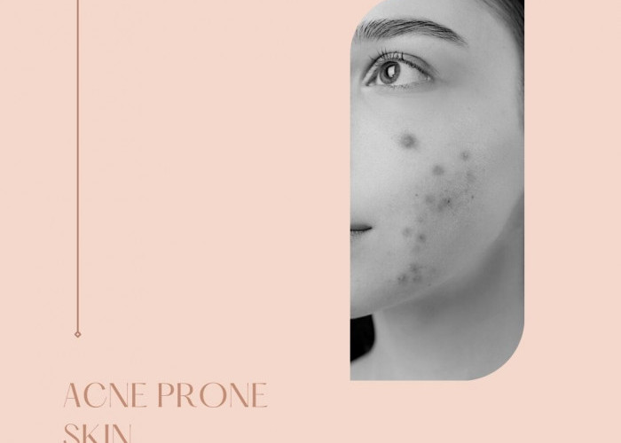 Punya Wajah Acne Prone Skin ? Begini Cara Merawatnya