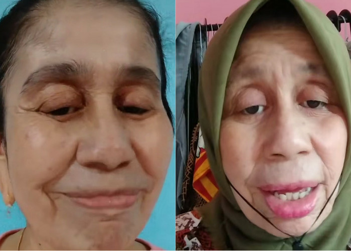 Kasihan! Wanita Usia 28 Tahun Tapi Wajahnya Seperti Nenek-nenek, Apa Nama Penyakitnya? 