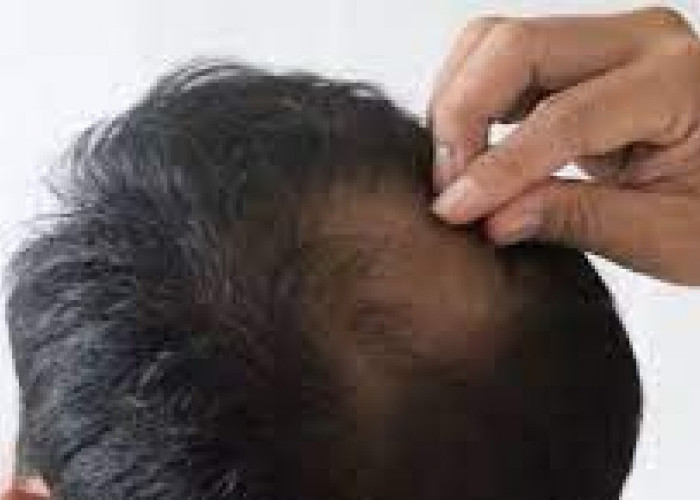 Manfaat Minyak Zaitun Ampuh untuk Menangani Rambut Botak di Usia 40-an