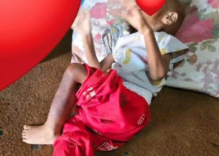 Balita 2 Tahun di Batang Gizi Buruk Ekstrem, Begini Intervensi Bupati